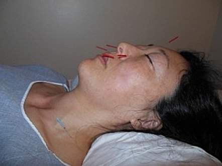 Facial acupuncture