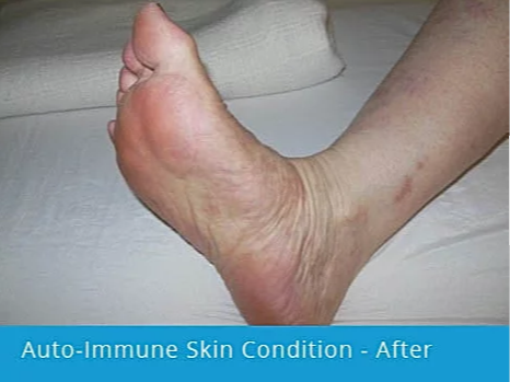 Auto-Immune Skin Condition on Foot: after picture