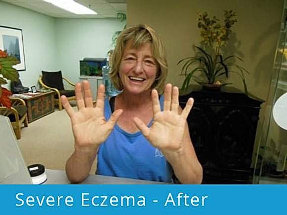 Severe Eczema: after picture