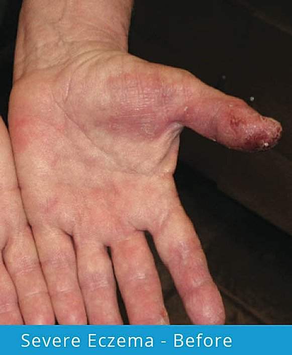 Severe Eczema: before picture