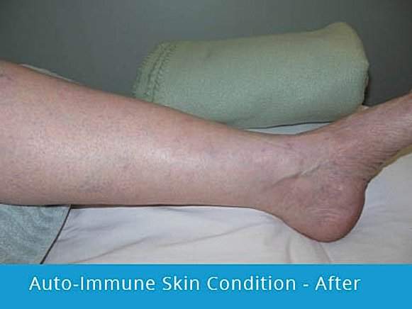 Auto-Immune Skin Condition: after picture