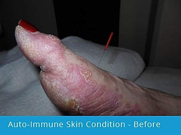 Auto-Immune Skin Condition on foot: before picture