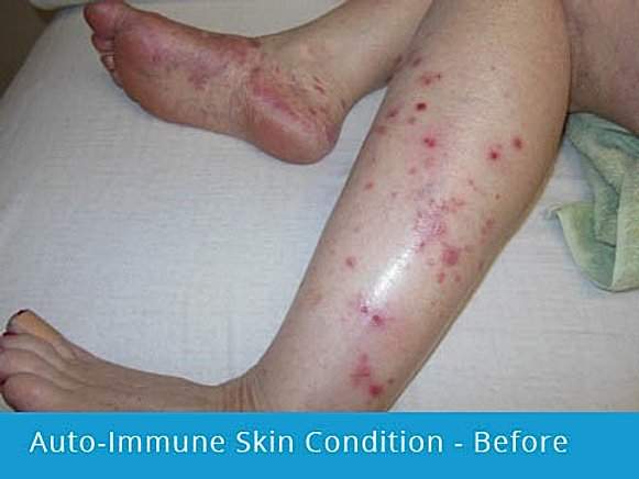 Auto-Immune Skin Condition: before picture